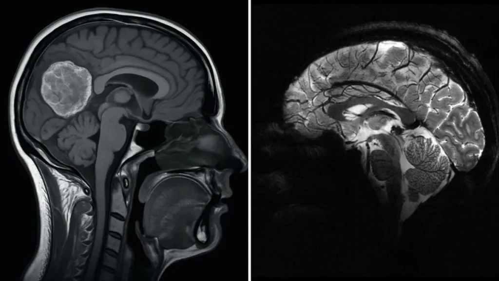 Tumor cerebral: Confira 4 sinais que o corpo dá e você jamais deve ignorar