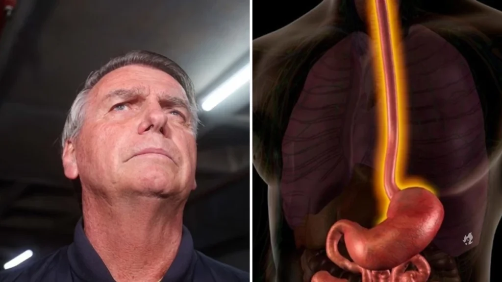 Saiba o que é a esofagite, doença diagnosticada em Bolsonaro