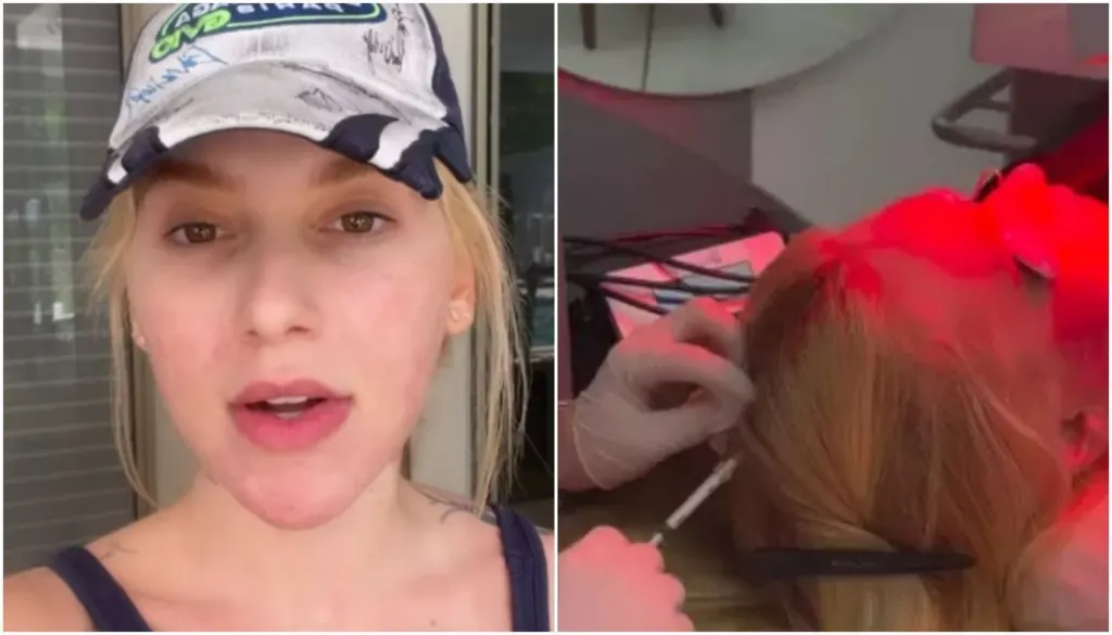 Alopecia areata: entenda doença de Virginia Fonseca e seus tratamentos